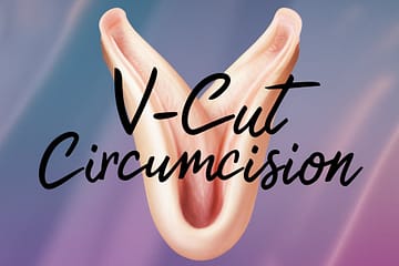 V-cut circumcision